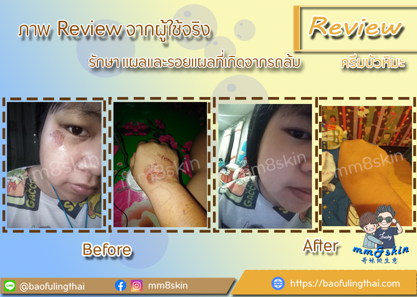 รีวิวครีมบัวหิมะ-รักษาแผลรถล้ม-แผลเกิดจากการถลอก